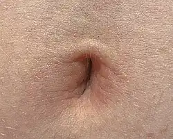 Nombril à cicatrice verticale