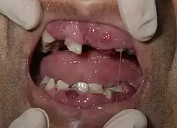 hypertrophie gingivale