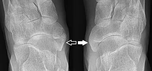 Type 2 sur un pied (flèche sombre) et type 3 sur l'autre (flèche blanche)