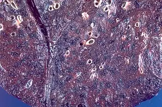 Description de l'image Anthracosis (4860889071).jpg.