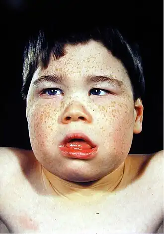 Enfant de huit ans avec les caractéristiques faciales de la maladie