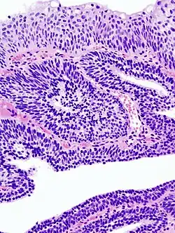 Papillome urothélial inversé de la vessie. HE, x400.