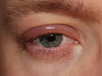 Description de l'image Blepharitis.JPG.