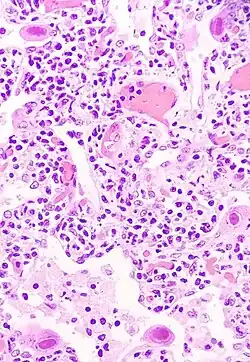 Image illustrative de l’article Cytomégalovirus, journal d'hospitalisation