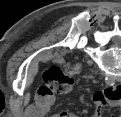 Avant l'ablation : crête supérieure arrière de l'ilion, avec une métastase ostéolytique (diam. environ 2&nbsp;cm, flèches)