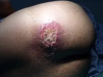 Description de l'image Carbuncle on buttok.JPG.