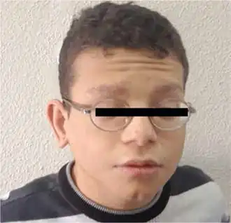 cheveux clairsemés sourcils fins