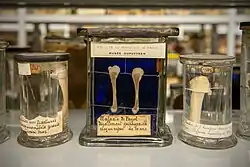 Décollement épiphysaire chez un enfant de 10 ans atteint de la maladie de Parrot.