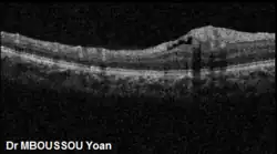 Coupe OCT d'une papille de Bergmeister