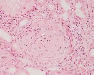 Description de l'image Crescentic glomerulonephritis HE stain.JPEG.