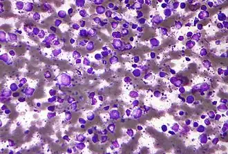 Description de l'image Diffuse large B cell lymphoma - cytology low mag.jpg.