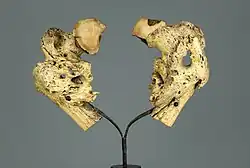 Fractures par coup de feu en dessous des deux trochanters