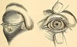Sécrétion anormalement abondante de chassie, signe d'une infection de l’œil.