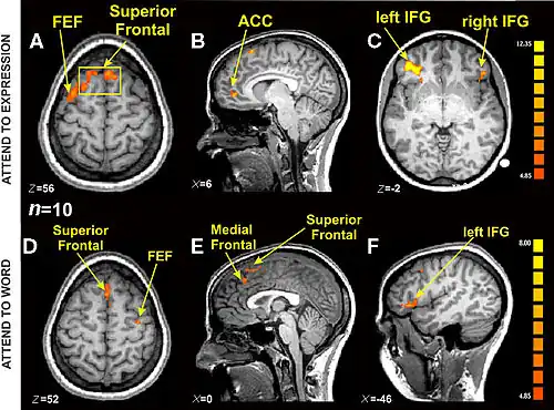planche sur fond noir représentant deux séries de trois coupes de cerveau humain dans deux plans de l'espace (horizontal et vertical), légendée en lettres jaunes