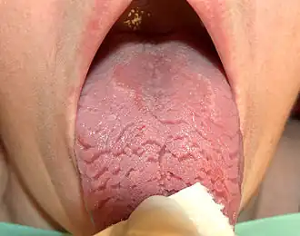 Description de l'image Fissured geographic tongue.jpg.