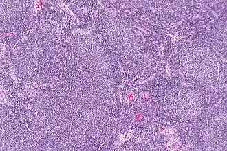 Description de l'image Follicular lymphoma -- low mag.jpg.