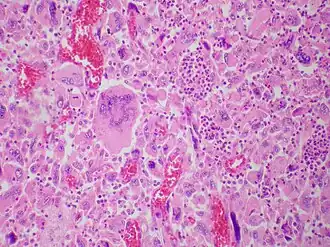 Description de l'image Giant cell carcinoma - Case 284 (13107156794).jpg.