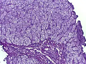 Description de l'image Glycogen storage disorder (PAS with diastase).jpg.