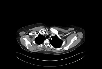 Description de l'image Hiperostosis EC.JPG.