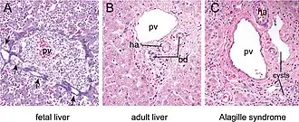 Description de l'image Histology of normal and defective intrahepatic bile ducts..jpg.