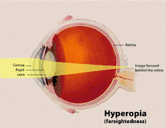 Description de l'image Hyperopia.gif.