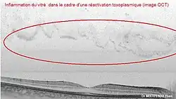 Inflammation du vitré secondaire à une toxoplasmose en coupe OCT