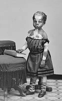 Photo de fillette afro-américaine atteinte de vitiligo.