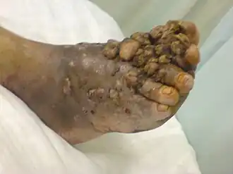 Description de l'image Madura foot.jpg.