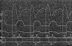 Sphygmographie intracardiaque: courbes de pression pulsée obtenue avec une cartographie des phases chronologiques de la contraction cardiaque, 1873.