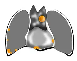 Dessin représentant un thymome stade IV.