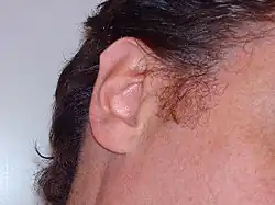 Tubercule auriculaire postérieur et pointu.