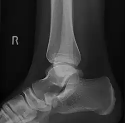 Projection latérale de type 2