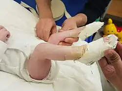  Pied Bot Varus Equin Bilatéral.