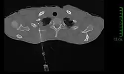 TDM thoracique en coupe coronale et fenêtre osseuse montrant une aiguille à ponction placée au sein d'une tumeur de l'apex pulmonaire.