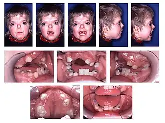 Description de l'image Patient with Apert syndrome.jpg.