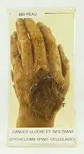 Peau : Cancer ulcéré et infiltrant de la collection « Musée d'anatomopathologie » (faculté de médecine)