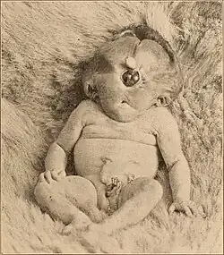 Sujet atteint de cyclopie en 1900.