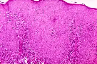 Description de l'image Pinta (disease).jpg.