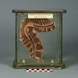 Portion de colonne vertébrale atteinte du mal de Pott.