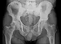 Radio du bassin d'un patient atteint d'un carcinome de la prostate : multiples métastases ostéocondensantes, en particulier sur le sacrum, mais aussi sur l'ilion surtout gauche (à dr. sur l'image), sur la pointe de l'ischion gauche, et sur le fémur proximal gauche. On détecte à l'occasion  une arthrose de hanche droite (à g. sur l'image).