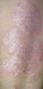 Un bras couvert de plaques de psoriasis.