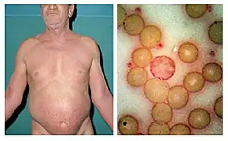 Description de l'image Sézary's disease.jpg.