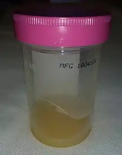 Exemple de liquide d'épanchement prélevé sur un genou infecté.