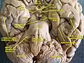 Cerveau. Vue inférieure. Dissection profonde.