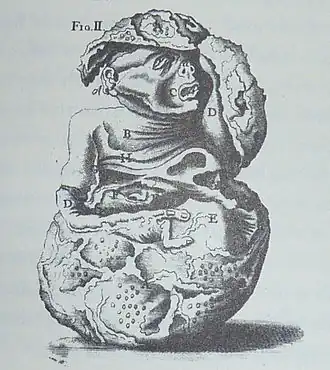 Représentation d'un lithopédion au XVIIIe&nbsp;siècle.