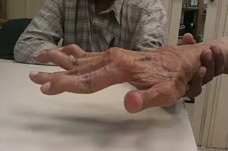 Description de l'image Swan neck deformity in a 65 year old Rheumatoid Arthritis patient- 2014-05-27 01-49.jpg.