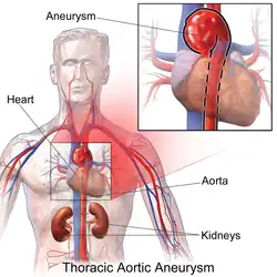 Description de l'image Thoracic Aortic Aneurysm.png.