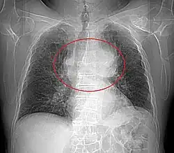 Radiographie thoracique montrant une masse volumineuse du médiastin antérieur débordant sur le poumon gauche et refoulant la trachée vers la droite.
