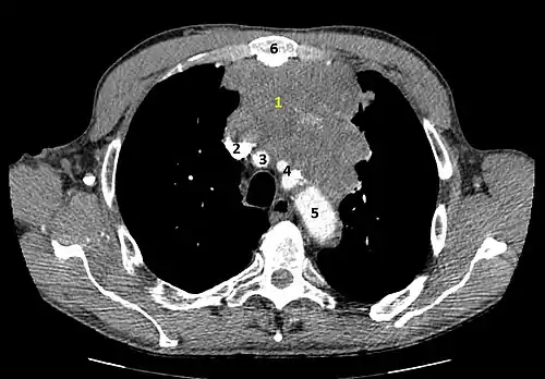 Coupe tomodensitométrique montrant une tumeur hétérogène envahissant localement les structures voisines. Le fenêtrage médiastinal et l'injection de produit de contraste permettent de voir au mieux le contact étroit avec les vaisseaux.