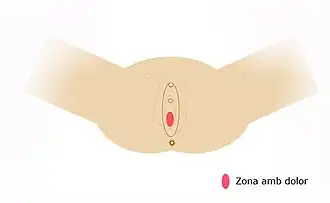 Description de l'image Vulvodínia localitzada.jpg.